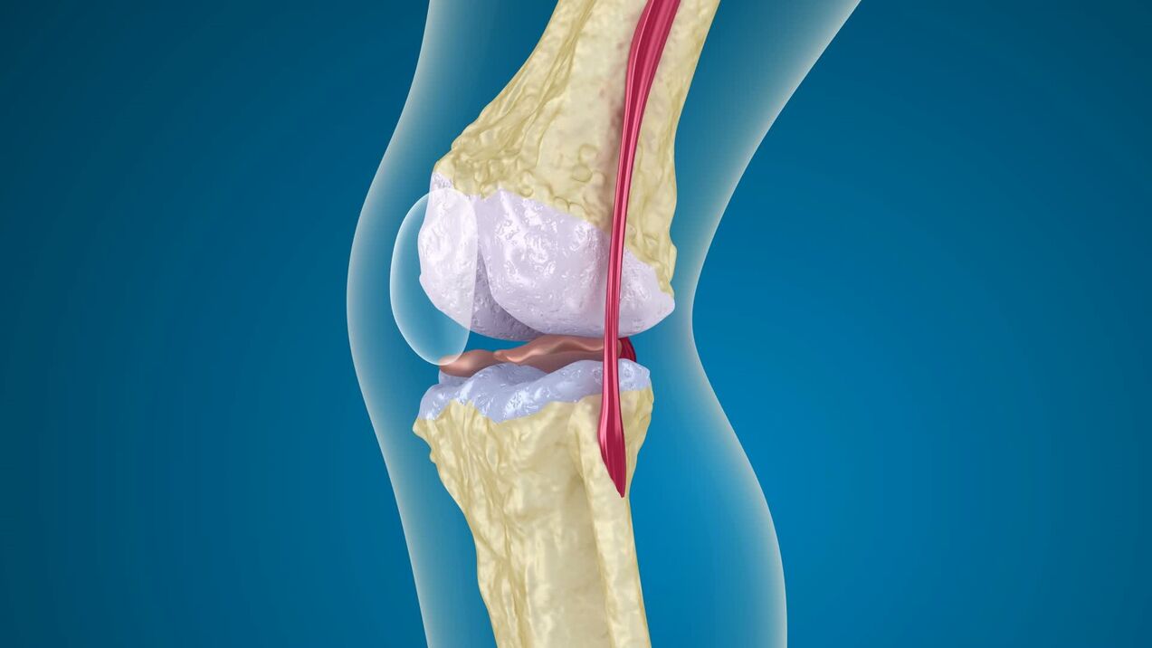 vernietiging van het kniegewricht met artrose
