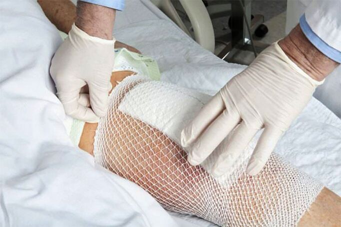 Therapeutisch kompres voor artrose van het kniegewricht