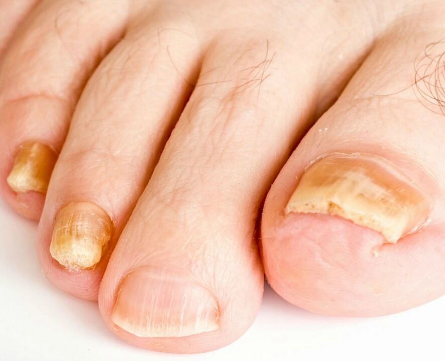 schimmel op de nagels