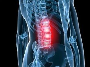 Osteochondrose van de lumbale wervelkolom