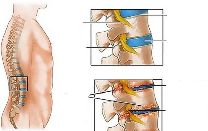 Osteochondrose van het lumbale gebied