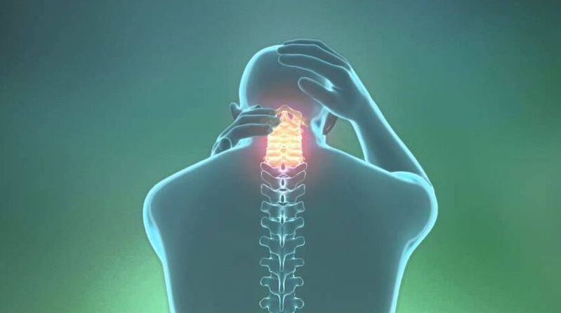 Osteochondrose van het cervicale gebied