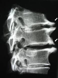 Osteofyten van de cervicale wervelkolom veroorzaken nekpijn