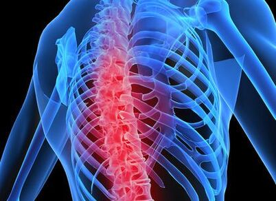 osteochondrose van de thoracale wervelkolom