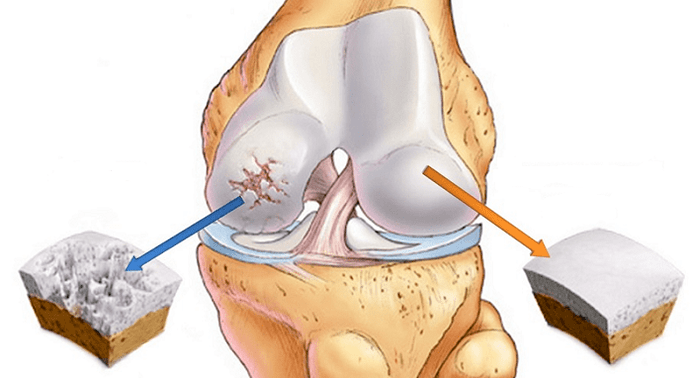gezond kraakbeen en kraakbeen aangetast door artrose