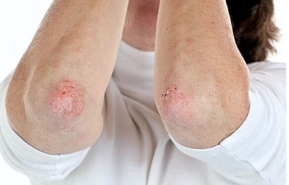 Mensen met psoriasis zijn vatbaar voor artritis psoriatica