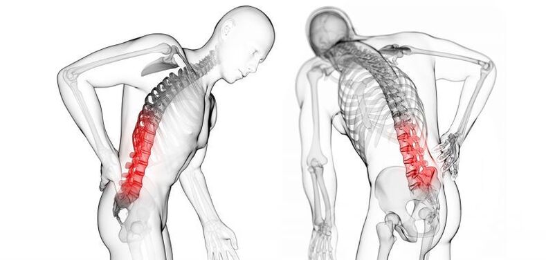 complicaties met cervicale osteochondrose