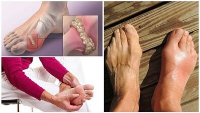 Wat is artritis van de gewrichten